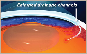 Canaloplasty Diagram