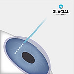 Bladeless LASIK Diagram 1