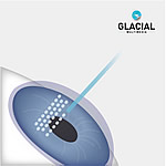 Bladeless LASIK Diagram 2