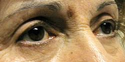 After Blepharoplasty Example