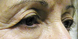 Before Blepharoplasty Example