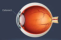Cataract Diagram