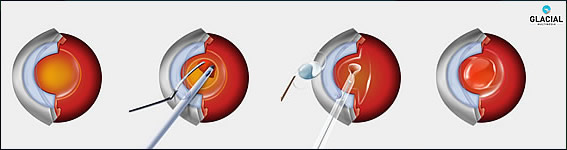 Cataract Surgery Beverly Hills Cataract Surgery Illustrated