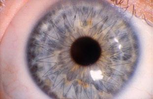 Example of corneal cross linking