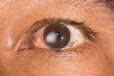 Close-up of a woman's eye before a cornea transplant