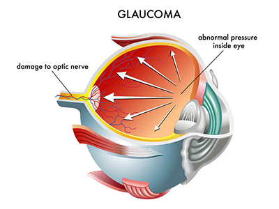 Chart showing an eye with glaucoma