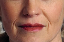 Before Restylane Treatment